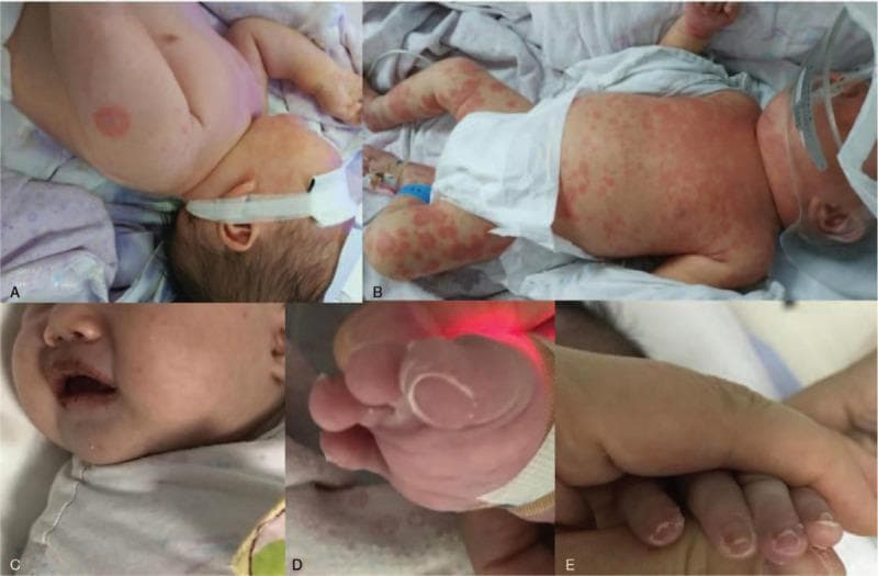 A composite of five clinical photographs (A-E) illustrating the progression of Kawasaki disease in an infant. Panel A shows an erythematous, targetoid, or ring-like skin lesion on the upper back/shoulder area, reminiscent of erythema multiforme. Panel B displays a diffuse, polymorphous erythematous rash consisting of confluent macules and papules across the trunk and lower extremities. Panel C focuses on the oropharynx, showing characteristic mucositis with dry, cracked, and fissured erythematous lips (cheilitis). Panels D and E demonstrate distal extremity changes, specifically subacute periungual desquamation (skin peeling) originating from the nail beds of the toes and fingers, respectively. This sequence captures the hallmark diagnostic features of Kawasaki disease, including polymorphous exanthema, mucosal changes, and late-stage desquamation. The visual evidence serves as a clinical reference for pediatric vasculitis and systemic inflammatory syndromes.