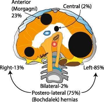 An anatomical diagram illustrating the classification and frequency of congenital diaphragmatic hernias (CDH) based on anatomical location. The illustration presents an axial view of the diaphragm, highlighting three primary defect sites: 1) Postero-lateral (Bochdalek) hernias, which are the most common at 75% of cases; 2) Anterior (Morgagni) hernias located retrosternally, accounting for 23%; and 3) Central hernias, representing 2%. The diagram further specifies the lateralization for Bochdalek hernias, indicating that 85% occur on the left side, 13% on the right side, and 2% are bilateral. Anatomical landmarks such as the vertebral column, esophagus, and major vessels are visible to provide orientation. This educational graphic is used to teach the epidemiology and spatial distribution of diaphragmatic defects in neonatology and pediatric surgery.