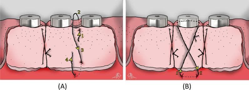 This medical illustration depicts two schematic views (A and B) of suturing techniques for securing a free gingival graft (FGG) around three dental implants in the mandible. Figure A illustrates the 'Double Vertical Interrupted Suture' technique used in the inter-implant areas. The diagram uses numbered yellow arrows (1–4) to show the needle's path: entering at the coronal aspect of the graft, passing through the lingual/palatal tissue, and re-entering apically to engage the periosteum before being tied at the graft base. This technique focuses on graft stabilization and adaptation to the underlying bed. Figure B demonstrates the 'Suspensory Cross-Mattress Suture' applied over each implant. This suture crosses diagonally over the implant abutment, forming an 'X' shape to ensure firm adaptation of the graft against the recipient bed, which is critical for establishing vascular supply. The illustration serves as an educational guide for periodontal or oral surgery, specifically for treating peri-implantitis and augmenting keratinized mucosa and vestibular depth.