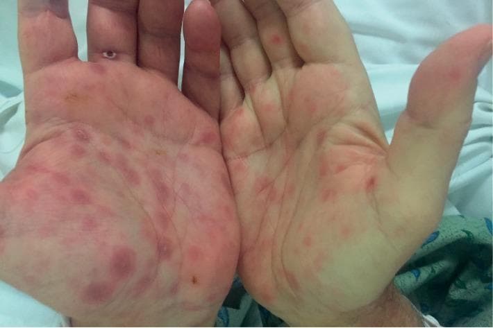 Clinical photograph of the palmar surfaces of both hands, demonstrating a bilateral, symmetric maculopapular eruption. The lesions are well-demarcated, varying in color from erythematous to dusky reddish-purple. The morphology consists of multiple round-to-oval macules and slightly raised papules, approximately 5-10 mm in diameter, distributed across the palms and extending onto the ventral surfaces of the fingers. Some lesions appear deeper in color with a copper-colored or ham-colored hue, characteristic of secondary syphilis. The surrounding skin is largely unremarkable, without significant edema or diffuse desquamation. In the clinical context of a genital chancre and high RPR titers, these findings are highly suggestive of the palmoplantar rash associated with secondary syphilis (syphilis stage II). This image serves as a classic diagnostic example of infectious dermatology for medical education, emphasizing the importance of examining the palms and soles in suspected systemic infections.