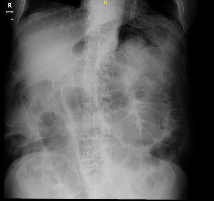 A supine plain film abdominal X-ray (diagnostic image) demonstrating multiple dilated loops of small bowel, concentrated primarily in the central and lower abdominal regions. The intestinal loops exhibit characteristic valvulae conniventes (plicae circulares) that span the entire diameter of the lumen, distinguishing them as small bowel. The distribution is disorganized and spans from the mid-abdomen toward the pelvic cavity. Notable features include the absence of visible pneumoperitoneum (no free air under the diaphragm) and a lack of significant gas in the distal colon or rectum, findings highly suggestive of a mechanical small bowel obstruction (SBO). Anatomical landmarks such as the lumbar vertebrae and pelvic bones are visible, providing orientation. This imaging is clinically significant for evaluating acute abdominal pain and suspected bowel obstruction, providing early diagnostic evidence for further cross-sectional imaging or surgical intervention.