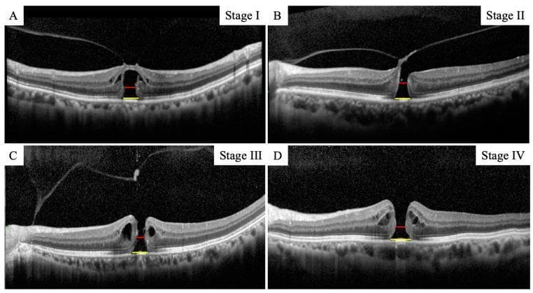 This composite diagnostic image features four Spectral-Domain Optical Coherence Tomography (SD-OCT) cross-sections of the human retina, illustrating the progression of macular holes (MH) graded according to the Gass classification (Stages I through IV). Panels A–D demonstrate the morphological evolution of the foveal architecture. Stage I (Panel A) shows an early foveal detachment with inner retinal disruption. Stages II and III (Panels B and C) exhibit progressively enlarging full-thickness retinal defects with associated intraretinal cystic changes and vitreomacular traction. Stage IV (Panel D) depicts a complete, large-diameter full-thickness macular hole with total vitreous separation. Annotated in each panel are measurement indicators: a yellow line representing the 'minimum MH size' (the narrowest point of the defect) and a red line representing the 'basal MH size' (the extent of the hole at the level of the retinal pigment epithelium). The series highlights key clinical biomarkers including retinal layer separation, cystic edema at the hole edges, and the widening of the hole diameter as the condition advances, which are critical for surgical planning and prognostic assessment in ophthalmology.