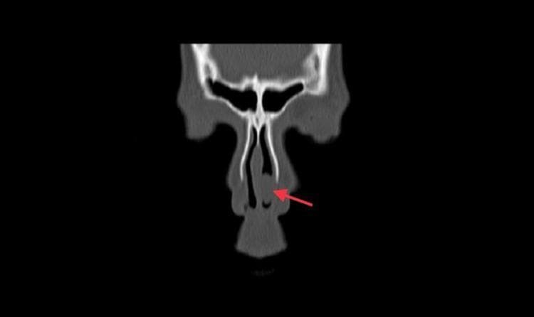 This diagnostic image is a non-enhanced coronal CT scan of the paranasal sinuses demonstrating a large antrochoanal polyp. The key visual finding is a significant soft tissue density (opacification) completely filling the left maxillary sinus and extending through a widened maxillary ostium into the left nasal cavity. A red arrow highlights a large, well-defined polypoidal mass within the left nasal fossa, which is causing local mass effect. Secondary findings include a significant deviation of the nasal septum toward the right side and compensatory hypertrophy of the right inferior turbinate (concha). The left inferior turbinate appears displaced and indented by the encroaching polypoidal mass. The sphenoid and frontal sinuses appear clear on this section. This image serves as a classic educational example of sinonasal polyposis and obstructive nasal pathology, illustrating the characteristic 'dumbbell' appearance of an antrochoanal polyp as it herniates from the sinus antrum into the nasal passage.