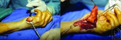 This clinical photograph sequence documents a surgical excision of a lipoma on the left hypothenar eminence. The left image shows the initial surgical field with a rounded, well-circumscribed mass protruding through an incision on the ulnar aspect of the palm, held by a metal retractor. The right image shows the advanced dissection where the lipoma is reflected, revealing its characteristic lobular morphology and yellowish-orange hue. The tumor is shown originating near Guyon's canal and the ulnar nerve bifurcation. Anatomical landmarks include the volar aspect of the wrist and the fourth and fifth digits. Surgical instruments, including skin hooks and retractors, are utilized to expose the deep muscular and connective tissues of the hand. This visual demonstrates the surgical management of a symptomatic lipoma causing compression neuropathy (ulnar nerve) and the intraoperative appearance of mature adipose tissue tumors within the complex anatomical compartments of the hand.