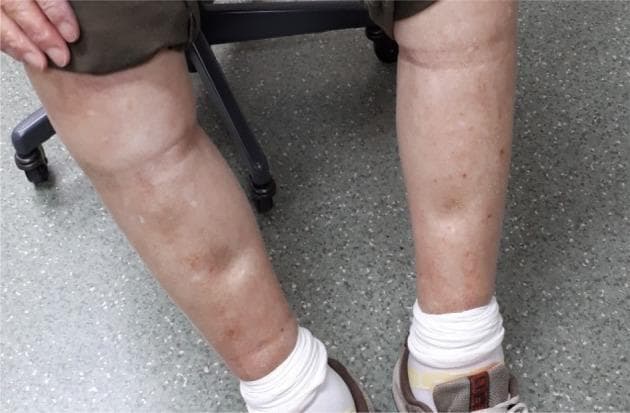 Clinical photograph of a patient's lower extremities demonstrating severe peripheral pitting edema. The legs show significant symmetrical swelling from the pretibial region down to the ankles, resulting in a loss of normal anatomical contours. A clear indentation (pitting) is visible on the medial aspect of the left leg where manual pressure was applied, characteristic of pitting edema. The overlying skin appears taut, shiny, and exhibits diffuse hyperpigmentation with scattered brownish macules and focal areas of hypopigmentation. The photograph illustrates a common adverse effect associated with BRAF/MEK inhibitor therapy (e.g., dabrafenib and trametinib) in the treatment of malignancies such as lung adenocarcinoma. The image is framed against a clinical background including a medical stool and the patient wearing white socks and athletic shoes, providing context for an outpatient or inpatient clinical assessment of Grade 3 edema.