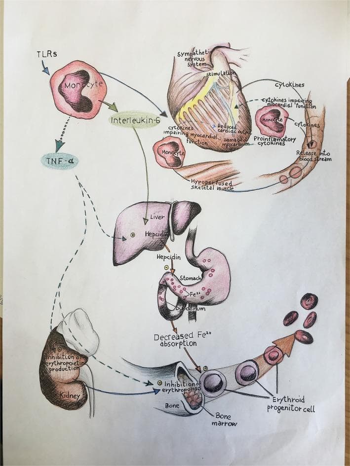 A pathophysiology diagram illustrating the multi-organ impact of immune-mediated inflammation in heart failure, specifically linking systemic cytokines to iron deficiency and anemia. The top of the schematic depicts a heart under stress, showing sympathetic nervous system stimulation, damaged myocardium, and reduced cardiac output. Monocytes activated via Toll-like receptors (TLRs) release pro-inflammatory cytokines, including Interleukin-6 (IL-6) and Tumor Necrosis Factor-alpha (TNF-α). The diagram shows IL-6 stimulating the liver to produce hepcidin, which inhibits Fe2+ absorption in the duodenum. Concurrently, TNF-α is shown causing the inhibition of erythropoietin production in the kidney and directly inhibiting erythropoiesis in the bone marrow. This suppression of erythroid progenitor cells, combined with decreased iron bioavailability, illustrates the mechanism behind the anemia of chronic disease and its role in worsening heart failure progression. The visual integrates cardiology, immunology, and hematology concepts, specifically targeting the clinical triad of inflammation, iron deficiency, and myocardial dysfunction.