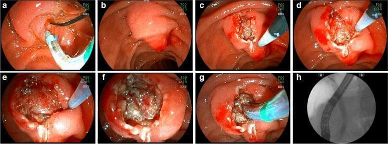 A series of eight panels (a-h) comprising seven endoscopic photographs and one fluoroscopic image, illustrating the steps of an Enlarged Fistulotomy of the Papilla (EFP) during Endoscopic Retrograde Cholangiopancreatography (ERCP). Panel (a) shows a failed initial cannulation attempt with a guide wire. Panel (b) depicts the endoscopic repositioning to visualize the papillary infundibulum. Panels (c) and (d) demonstrate a needle-knife fistulotome performing a wide longitudinal incision from the transverse crease followed by lateral incisions. Panels (e) and (f) highlight the exposure of the submucosa and identification of the muscular sphincter fibers, which are carefully sectioned to reveal the common bile duct (CBD) mucosa. Panel (g) shows successful cannulation of the exposed CBD. The final panel (h) is a fluoroscopic radiograph (cholangiogram) confirming deep cannulation and contrast distribution within the biliary tree. The sequence illustrates a surgical alternative for difficult biliary access, emphasizing the dissection of anatomical layers from the mucosal surface to the muscularis propria of the papilla.