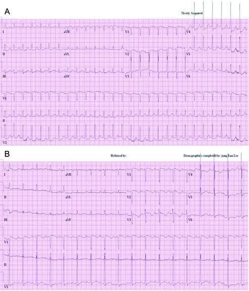 This diagnostic image displays two 12-lead electrocardiograms (ECGs), labeled A and B, illustrating dynamic ST-segment changes in a clinical setting. Panel A shows a tachycardic rhythm with significant horizontal and downsloping ST-segment depression in the lateral precordial leads (V4, V5, and V6), indicative of acute myocardial ischemia. Corresponding T-wave flattening or inversion is also visible in these leads. Panel B presents a follow-up ECG of the same patient after resolution of symptoms, demonstrating a return of the heart rate to baseline and the recovery of the ST segments toward the isoelectric line. The T-waves in leads V4-V6 show improved morphology and are more upright compared to the initial tracing. This comparison chart is an educational resource for cardiology and emergency medicine, highlighting the ECG manifestations of demand-induced ischemia or acute coronary syndrome and the subsequent normalization following clinical stabilization.