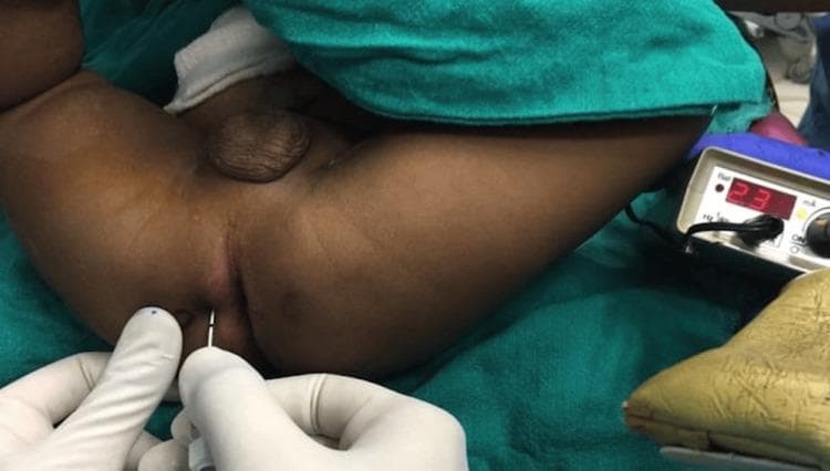 This clinical procedural photograph demonstrates the technique for a pediatric pudendal nerve block (PNB) using nerve stimulator guidance. The patient is positioned in the lithotomy position, with the perineal region exposed under sterile conditions. A clinician, wearing sterile gloves, is seen performing the block by inserting a specialized nerve stimulator needle (typically 22-24 gauge) into the perineum. The needle is positioned at approximately the 3 o'clock location relative to the anus, midway between the anus and the ischial tuberosity. To the right of the procedural field, a nerve stimulation device is visible, displaying a digital output of '2.3 mA', which is used to localize the nerve by monitoring for motor responses (e.g., penile movement). The image highlights key anatomical landmarks and the precise needle trajectory required for regional anesthesia in the pudendal distribution, commonly used for postoperative pain management in penile surgeries such as hypospadias repair. This content is intended for intermediate to advanced medical training in pediatric anesthesia and pain management.