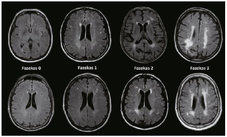 This diagnostic comparison chart features axial Fluid-Attenuated Inversion Recovery (FLAIR) MRI scans of the brain, illustrating the Fazekas scale for grading white matter hyperintensities (WMH). The image is organized into four columns representing Fazekas grades 0 through 3. Fazekas 0 (Normal) shows an absence of lesions. Fazekas 1 (Mild) displays isolated, punctate hyperintensities in the deep white matter or thin 'caps' at the ventricular horns. Fazekas 2 (Moderate) demonstrates larger, more numerous lesions beginning to coalesce, appearing as smooth 'halos' in periventricular regions. Fazekas 3 (Severe) reveals large, confluent hyperintensities that extensively involve both periventricular and deep white matter areas, creating irregular, irregular masses of high signal. These scans are critical for evaluating small vessel disease and its association with vascular cognitive impairment (VCI) and dementia. The educational focus is on identifying the morphology, distribution, and clinical progression of ischemic white matter changes.