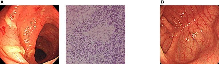 This composite clinical figure illustrates the treatment response in a patient with XIAP deficiency-associated inflammatory bowel disease (IBD). Panel A displays pre-treatment findings including a colonoscopic view and a histopathology slide. The endoscopy shows significant mucosal inflammation characterized by marked edema, friability, spontaneous hemorrhage, and whitish fibrinous ulcerations. The adjacent H&E-stained biopsy specimen reveals nonspecific active inflammation with a dense infiltrate of mononuclear cells and neutrophils, alongside architectural disruption. Panel B presents a follow-up colonoscopic image after allogeneic cord blood transplantation (CBT). It demonstrates complete mucosal healing with the restoration of normal vascular patterns, resolution of edema, and absence of ulcerations or hemorrhage. The educational focus is on the efficacy of hematopoietic stem cell transplantation as a curative option for monogenic PIDs presenting with refractory early-onset IBD, highlighting the clinical transition from severe inflammatory pathology to endoscopic remission.