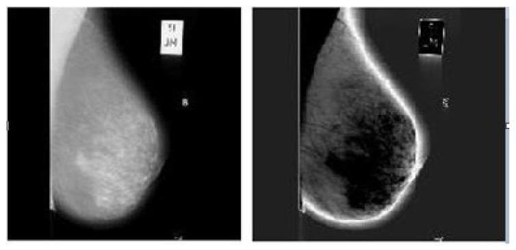 This medical comparison chart displays two mammography X-ray images of the human breast, illustrating the effects of digital image pre-processing. The image on the left is the 'Selected Input Image,' a mediolateral oblique (MLO) view showing the breast tissue with characteristic granular texture and varying radiodensity against a high-contrast black background. A radiographic label is visible in the upper right. The image on the right is a 'Smoothened Image' processed with a Gaussian filter (5x5, sigma=2) for noise reduction. This version exhibits significantly softer edge definition and a more uniform texture within the fibroglandular tissue, intended to prepare the image for region-of-interest (ROI) segmentation and feature extraction. Visual artifacts include a halo-like brightening effect along the skin line in the processed image and blurred radiographic markers. This comparison is clinically relevant for evaluating image enhancement models used in computer-aided detection (CAD) systems for breast cancer screening and classification of benign versus malignant lesions.