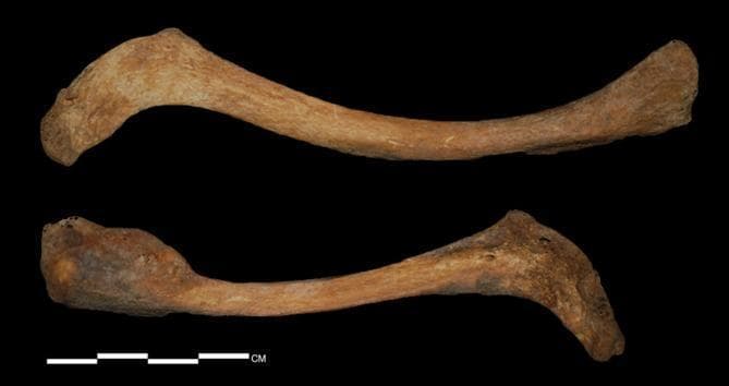A clinical photograph of human skeletal remains showing the superior surface of two clavicles (upper bone: left side; lower bone: right side) against a black background. Both specimens display the characteristic S-shaped curvature. Significant bilateral asymmetry is visible between the two bones. The left clavicle (upper) is relatively slender with a smoother surface texture and expanded articular ends. The right clavicle (lower) is notably thicker and wider at the medial portion, appearing more flattened and angulated along the postero-inferior midshaft. The cortical surface of the right clavicle shows increased porosity, rougher texture, and focal areas of discoloration compared to the left. On the lateral end of the left clavicle, a distinct foramen is visible with evidence of localized periosteal reaction. These morphological findings are consistent with pathological asymmetry and possible systemic or localized skeletal disorders in a bio-archaeological context.