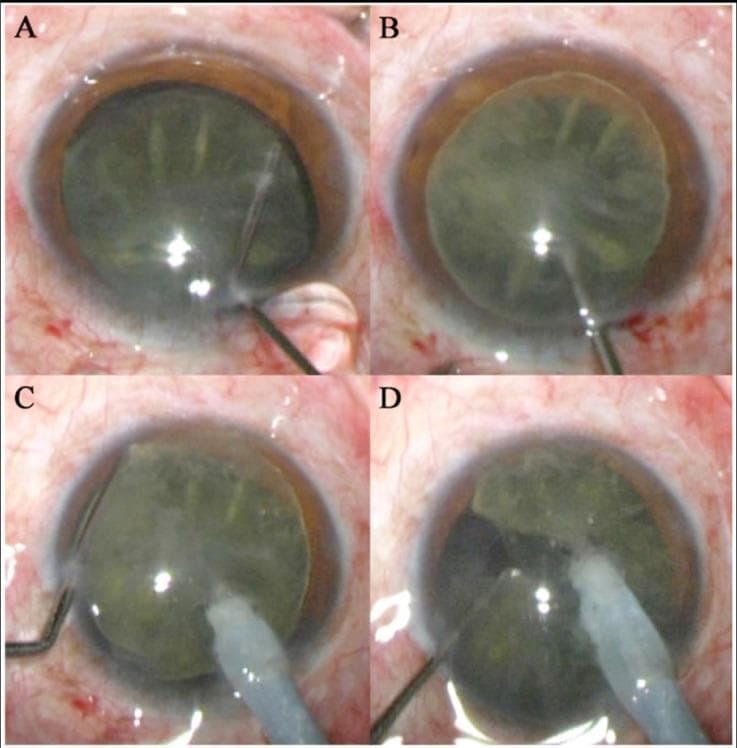 A series of four intraoperative clinical photographs (A-D) demonstrating critical stages of phacoemulsification cataract surgery. Frame A shows hydrodissection where fluid is injected into the eye using a thin cannula to separate the lens nucleus from the capsule. Frame B depicts nucleus rotation, confirming successful mobilization. Frames C and D illustrate the bimanual 'stop and chop' or 'phaco chop' technique: a large-bore phacoemulsification tip provides vacuum to hold the lens nucleus firmly in the center of the pupillary field, while a metallic second instrument (chopper) is hooked around the equator of the nucleus and moved centripetally to fragment the crystalline lens. The images highlight the anatomical relationship between the dilated pupil, the anterior capsule, and the surgical instrumentation within the anterior chamber. This series serves as an educational resource for ophthalmic surgical training, focusing on nucleus manipulation and fragmentation strategies during cataract extraction.