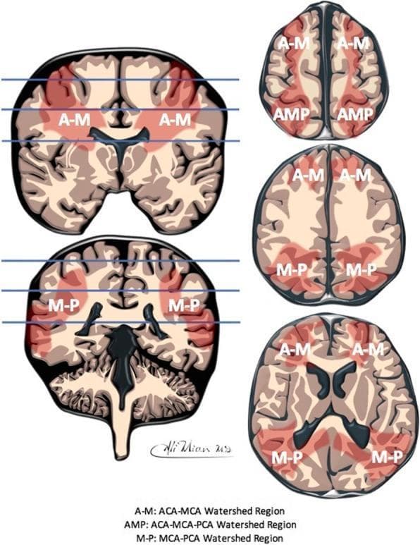 This medical illustration presents a schematic representation of the inter-arterial watershed regions of the human brain. The content is organized into two primary columns: the left column features two coronal cross-sections with horizontal blue lines indicating the anatomical levels of the corresponding three axial cross-sections shown in the right column. A red semi-transparent overlay highlights the boundary zones between major cerebral arterial territories. Letter annotations identify specific confluence zones: 'A-M' denotes the watershed between the Anterior Cerebral Artery (ACA) and Middle Cerebral Artery (MCA), primarily seen in the superior and lateral frontal regions; 'M-P' indicates the boundary between the MCA and Posterior Cerebral Artery (PCA) in the parieto-occipital and temporal regions; and 'AMP' signifies the triple-confluence of ACA, MCA, and PCA located at the vertex/midline. This diagram is designed for educational indexing in neurology and radiology, illustrating the anatomical distribution of regions most susceptible to hypoperfusion and watershed infarction in both adult and neonatal populations.