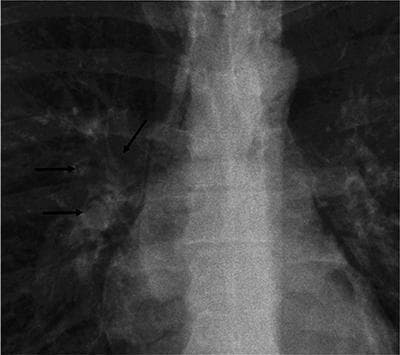 This diagnostic image is a focused frontal view of a chest radiograph (X-ray) centered on the mediastinum and right hilar region. The primary finding is an 'air crescent sign' located in the right hilum, indicated by three black arrows. The sign consists of a curvilinear, crescent-shaped lucency (airspace) that partially surrounds a rounded soft-tissue opacity within a cavitary lesion. This radiographic phenomenon typically represents air trapped between a central mass and the wall of a cavity. While commonly associated with invasive pulmonary aspergillosis (Monod sign), the clinical context here demonstrates the sign in the right hilar vessels, characteristic of pneumomediastinum or pulmonary interstitial emphysema. The image highlights key anatomical landmarks including the trachea, vertebral column, and cardiac silhouette, serving as an educational example of identifying subtle gas patterns in thoracic radiology.
