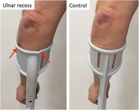 This clinical comparison photograph displays two types of forearm crutch cuffs being used on a human subject. The left image shows an 'ulnar recess' anatomic cuff, while the right image shows a 'control' (conventional) cuff. In the ulnar recess design, red arrows highlight two specific indentations along the superior aspect of the plastic cuff. These indentations create a visual gap between the cuff material and the forearm, specifically targeting the area over the ulnar bone and proximal forearm to redistribute weight-bearing pressure. In contrast, the conventional control cuff demonstrates a uniform, continuous curve that maintains direct contact with the limb. Both forearms exhibit visible skin discoloration and bruising near the elbow joint, likely related to chronic crutch use. This image illustrates an orthopedic intervention designed to mitigate ulnar nerve compression, periosteal pain, and skin irritation in patients requiring long-term mobility aids by optimizing the crutch-forearm interface.