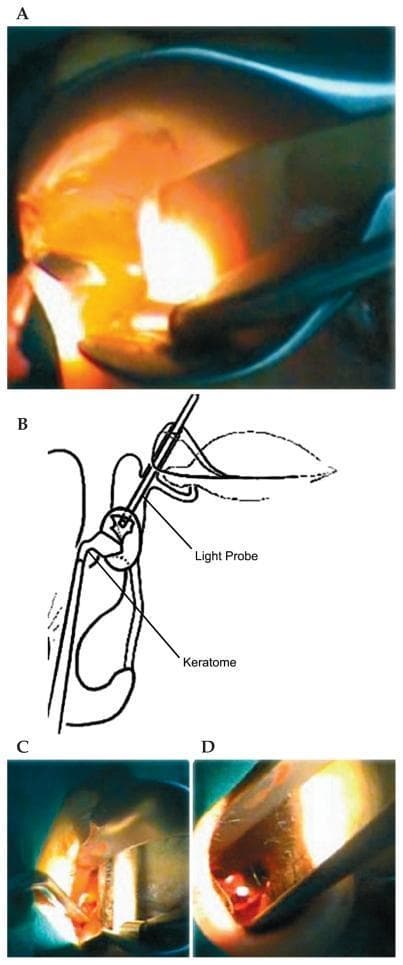 This composite educational image illustrates the key surgical steps of an endonasal dacryocystorhinostomy (DCR). Panel A is a clinical photograph showing transillumination of the lateral nasal wall, achieved by a light probe inserted through the canaliculus into the lacrimal sac. Panel B is a corresponding anatomical diagram labeling the spatial relationship between the 'Light Probe' (entering via the upper canaliculus) and the 'Keratome' used to incise the medial wall of the lacrimal sac. Panels C and D provide intraoperative endoscopic views using a nasal speculum. Panel C depicts the incision of the nasal mucosa and exposure of the lacrimal fossa, while Panel D shows the subsequent lacrimal sac flap removal and excision using forceps. The series demonstrates the use of transillumination as a guide for precise osteotomy and sac incision in ophthalmologic and ENT surgery for treating nasolacrimal duct obstruction.