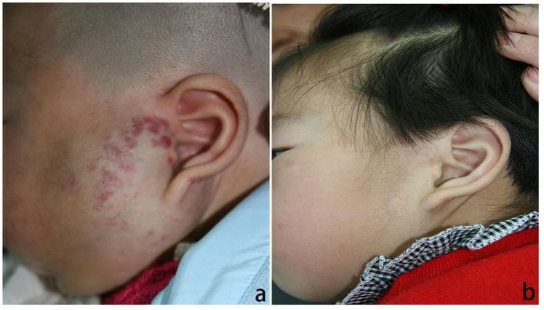 This clinical photograph represents a comparison chart of an infantile hemangioma before and after treatment. Image (a) depicts a 3-month-old male with a large, segmental infantile hemangioma located in the left parotid and preauricular region. The lesion is characterized by a cluster of raised, bright red to purple papules and plaques with a mottled distribution. Image (b) shows the same patient at 10 months of age following a course of oral propranolol therapy. There is a significant clinical resolution of the vascular tumor, showing near-complete involution of the hemangioma with minimal residual telangiectasia and healthy skin texture. This comparison illustrates the efficacy of beta-blocker therapy in managing proliferative infantile hemangiomas, particularly in high-risk areas like the parotid region where deep growth could affect underlying structures. This content is suitable for dermatology and pediatric education regarding vascular anomalies and pharmacological intervention outcomes.