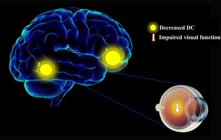 A pathophysiology diagram illustrating the relationship between pathological myopia (PM) and functional brain changes. The visual includes a 3D rendering of the human brain and a cross-sectional illustration of the human eye. Two distinct yellow circular highlights, labeled '1' and '2', identify regions of decreased Degree Centrality (DC) in patients with PM compared to healthy controls. Region 1 is located in the right anterior cingulum (Brodmann area 11), and region 2 corresponds to the right fusiform gyrus (Brodmann area 37). Lines connect these cerebral regions to the ocular model, which contains a downward-pointing arrow and an orange glow in the posterior segment (fundus), symbolizing impaired visual function and pathological retinal changes. This image serves to demonstrate how chronic visual impairment in high myopia can lead to neuroplastic alterations and decreased functional connectivity in specific cortical and subcortical pathways involved in visual processing and executive function.