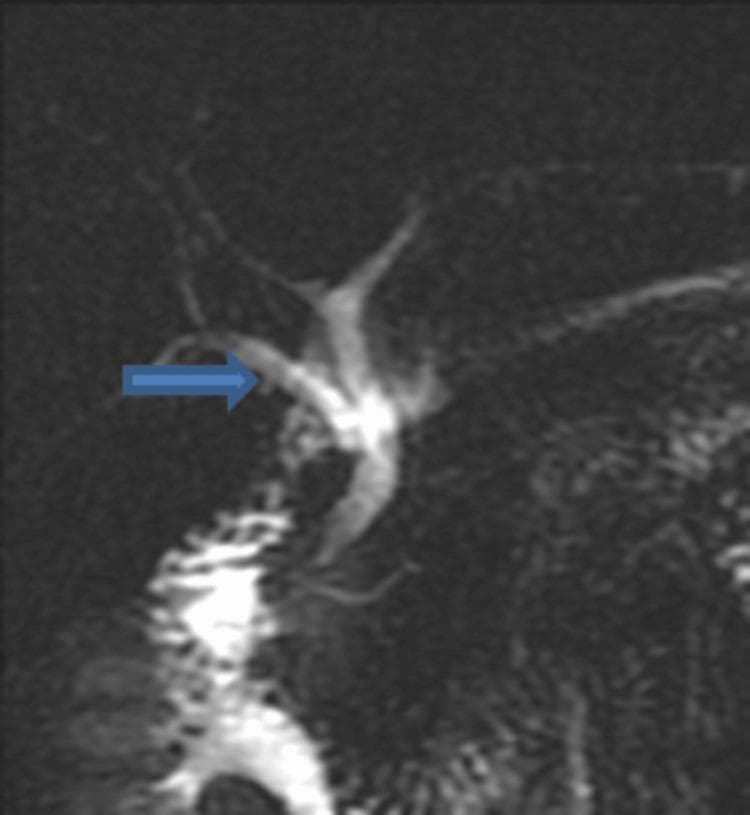 A Magnetic Resonance Cholangiopancreatography (MRCP) or T2-weighted diagnostic image demonstrating an anatomical variation of the biliary tree. The image shows high-signal intensity (fluid-filled) tubular structures representing the bile ducts against a dark background. A blue arrow points to the right posterior sectoral duct, which is clearly visualized merging directly into the common bile duct rather than its standard confluence with the right anterior sectoral duct. The biliary anatomy displays a branching pattern where multiple segmental ducts converge, and the common bile duct is seen descending towards the duodenum. This diagnostic image is used in clinical education to illustrate congenital anatomical variations that are critical for preoperative planning in hepatobiliary and pancreatic surgeries.