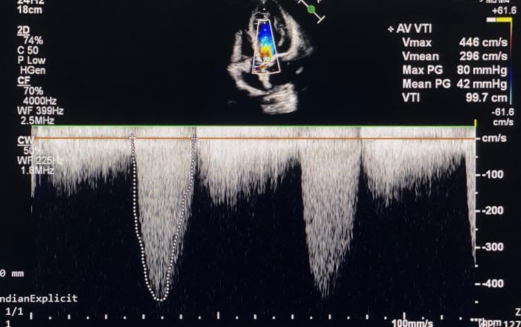 A diagnostic image showing a continuous-wave (CW) Doppler echocardiogram of the aortic valve, utilized for assessing hemodynamics in a patient with severe aortic stenosis. The display is divided into a top section featuring a 2D transthoracic apical five-chamber view with color flow mapping and a bottom section showing the spectral Doppler tracing. The spectral envelope is dense and high-velocity, appearing below the baseline, indicating high-speed flow away from the transducer. Quantitative hemodynamic measurements for the aortic valve (AV VTI) are displayed on the right: a maximum velocity (Vmax) of 446 cm/s, a mean velocity (Vmean) of 296 cm/s, a peak pressure gradient (Max PG) of 80 mmHg, a mean pressure gradient (Mean PG) of 42 mmHg, and a velocity time integral (VTI) of 99.7 cm. These parameters are diagnostic of severe aortic stenosis. The tracing shows a typical dagger-shaped or triangular morphology associated with valvular obstruction. This visual is intended for cardiology education regarding valvular heart disease and Doppler quantification.