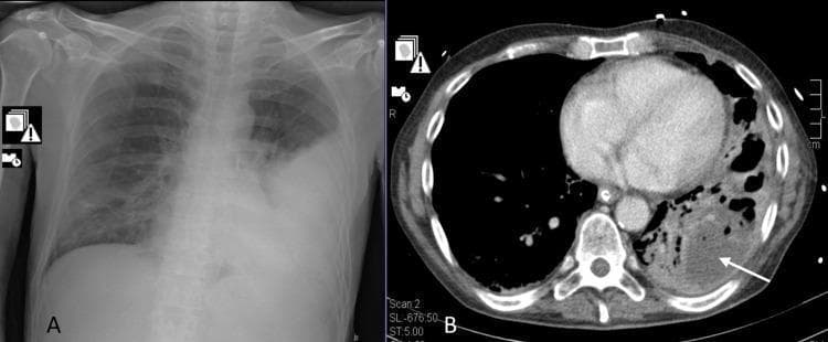 The composite image displays two diagnostic modalities for the chest. Image A is a frontal chest X-ray (radiography) demonstrating extensive opacification and consolidation in the left lower lung field, consistent with lobar pneumonia. The heart border is obscured, and the left costophrenic angle is obliterated. Image B is an axial computed tomography (CT) scan of the chest at the level of the heart, showing the evolution of the pathology. It reveals a large area of consolidation in the left posterior lung containing multiple low-density, hypodense regions. A white arrow points to a well-defined pulmonary abscess and surrounding cavitation within the necrotizing lung tissue. The right lung remains relatively clear on both modalities. These images illustrate the clinical progression from initial community-acquired pneumonia to necrotizing pneumonia and abscess formation, a significant complication often associated with specific bacterial pathogens or co-infections.