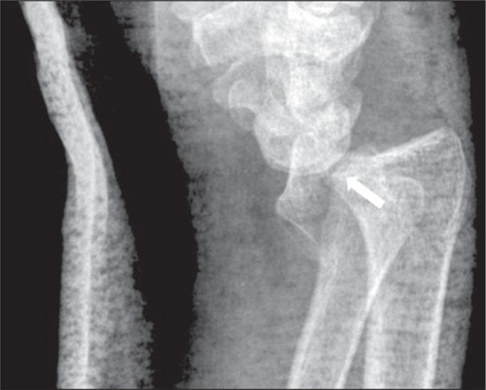 This lateral X-ray of the wrist demonstrates a volar Barton fracture, a specific type of distal radius injury. The diagnostic image clearly shows a partial articular fracture involving the volar rim of the distal radius (indicated by a white arrow), which extends into the radiocarpal joint space. Significant volar dislocation of the carpus is evident, characterized by the displacement of the carpal bones towards the palmar side of the wrist, resulting in a complete loss of normal radiocarpal alignment. Key anatomical landmarks visible include the distal radius, distal ulna, and the proximal carpal row. This injury pattern typically results from high-energy trauma or falls and is clinically significant for its inherent instability, often requiring surgical intervention to restore joint congruence. The image serves as a classic educational example of a volar-type shear fracture-dislocation of the distal radial articular surface.