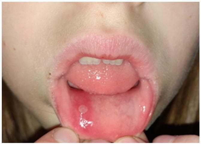 This clinical photograph displays a case of aphthae minor, a common oral ulcerative condition. The image shows the intraoral cavity of a patient with the lower lip everted to reveal a single, well-demarcated minor aphthous ulcer (canker sore). The lesion is approximately 5-8 mm in diameter, characterized by a shallow, circular-to-oval shape with a yellowish-white pseudomembranous base consisting of fibrin and cellular debris. A distinct, bright red (erythematous) halo surrounds the ulcerated area, indicating localized inflammation. The surrounding labial mucosa appears moist and otherwise healthy. The tongue is visible in the background with normal morphology, and there are no signs of generalized stomatitis. This image serves as a classic diagnostic example of Recurrent Aphthous Stomatitis (RAS) for medical and dental education, highlighting the morphological hallmarks used to differentiate minor aphthae from major or herpetiform ulcers.