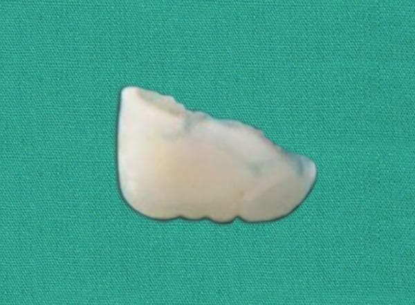 Clinical photograph of a surgically retrieved tooth fragment placed against a green surgical backdrop. The specimen is a portion of a fractured maxillary central incisor (tooth 21). The fragment displays the morphological characteristics of an incisal edge, including a slightly serrated or mamelon-like inferior border. The enamel appears off-white to translucent with a visible fracture line along the superior aspect, characterized by a rough, uneven, and jagged surface where it detached from the crown. This image illustrates a case of dental trauma where a fractured tooth segment was embedded in soft tissue (the lip) and recovered for potential reattachment. The specimen is clean, showing no significant attrition or secondary decay, which is clinically relevant for evaluating the feasibility of biological restoration and adhesive bonding in pediatric dentistry.