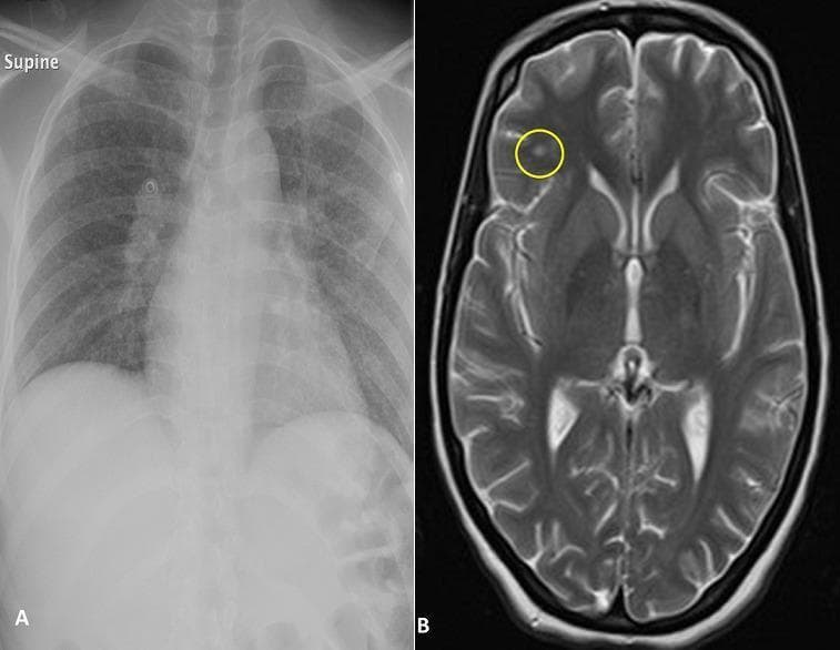 This composite diagnostic image consists of two panels labeled A and B, illustrating multi-organ manifestations of a systemic disease, likely tuberculosis or sarcoidosis. Panel A is a supine frontal chest X-ray (CXR) showing bilateral hilar lymphadenopathy and diffuse, fine, nodular opacities throughout both lung fields, characteristic of a miliary pattern. Panel B is a T2-weighted axial brain MRI (magnetic resonance imaging) showing a single, well-circumscribed hyperintense focal lesion in the left frontal lobe cortex (highlighted by a yellow circle), suggestive of a granuloma or tuberculoma. The MRI also demonstrates normal ventricular size and preserved sulcal patterns. This comparison is educationally significant for demonstrating the concurrent involvement of the respiratory and central nervous systems in disseminated granulomatous diseases. Target audience includes medical students and radiology residents focusing on infectious diseases and neuroradiology.