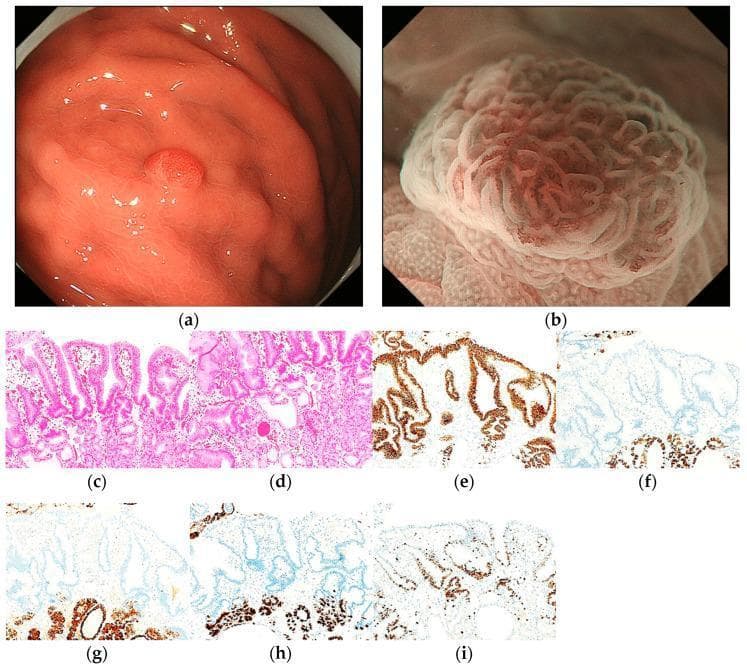 This composite figure illustrates the endoscopic and histopathological features of a proton pump inhibitor-related lesion (PPI-L) with low-grade dysplasia. (a) White-light imaging (WLI) reveals a 6 mm, homogenous reddish, protruded lesion located on the greater curvature of the upper gastric third. (b) Magnifying endoscopy with narrow-band imaging (ME-NBI) demonstrates a regular microvascular (MV) pattern and a regular microsurface (MS) pattern, bordered by a distinct demarcation line. (c, d) H&E stained sections at 100x magnification show parietal cell hyperplasia, foveolar epithelial dilation and elongation, and stromal vascularity. (e–i) Immunohistochemical analysis (100x) displays strong MUC5AC positivity in foveolar epithelial cells, while MUC6 (f), pepsinogen-I (g), and H+/K+-ATPase (h) are negative. (i) Ki-67 immunostaining reveals a high labeling index (80%), indicating significant cellular proliferation. The image serves as an educational reference for differentiating benign-appearing gastric protruded lesions from early gastric cancer using the MESDA-G diagnostic algorithm.