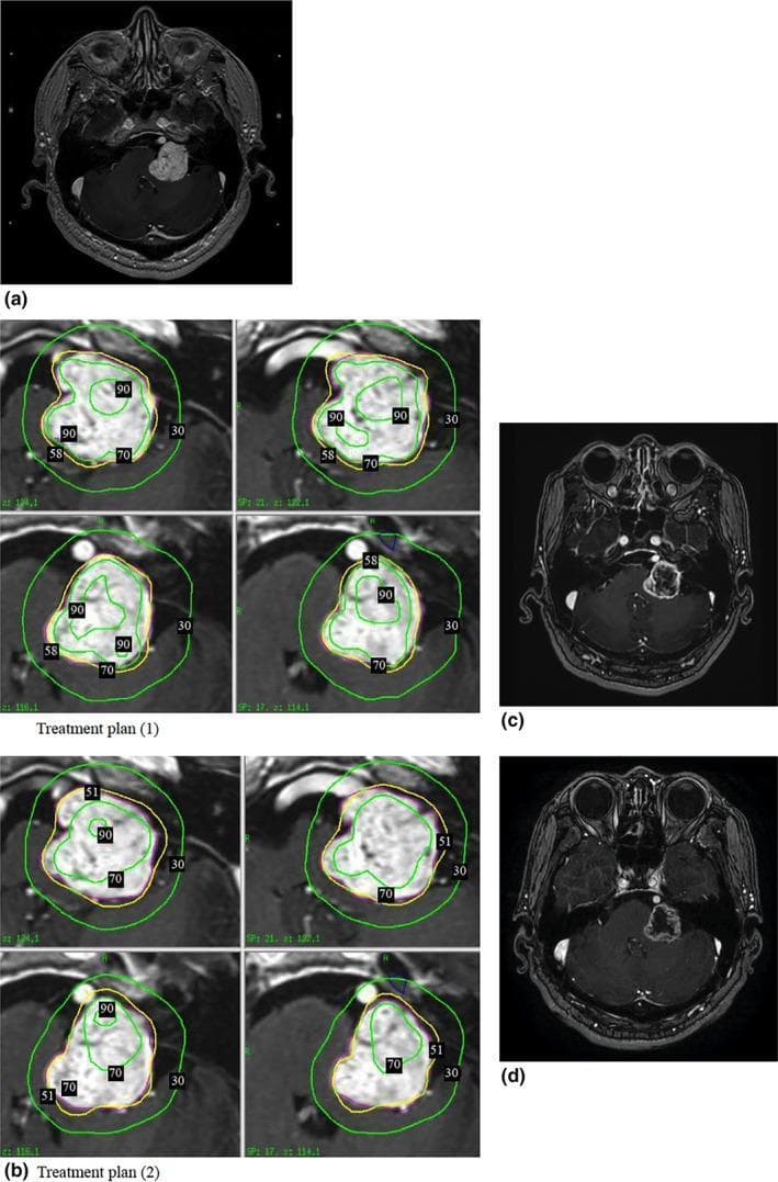 This composite figure illustrates a clinical case of a left-sided acoustic neuroma (vestibular schwannoma) and its response to Gamma Knife Radiosurgery (GKRS). Panel (a) shows a pre-treatment axial T1-weighted contrast-enhanced MRI demonstrating a large, well-defined, intensely enhancing mass in the left cerebellopontine angle with significant compression of the adjacent brainstem and cerebellum. Panel (b) provides a detailed comparison of two radiation treatment plans, displaying isodose curves (e.g., 90%, 70%, 58/51%, and 30% lines) superimposed on the tumor volume to demonstrate dose distribution and conformity. Panels (c) and (d) present longitudinal follow-up axial MRIs at 6 and 12 months post-treatment, respectively. These images demonstrate progressive therapeutic effects, including a marked loss of central contrast enhancement (indicating central necrosis or reduced vascularity) and a significant reduction in tumor volume (shrinking from 11.5 cm³ to 8.3 cm³). The images confirm the absence of adverse radiation-induced effects, such as perifocal edema or mass effect increase, highlighting the efficacy of the treatment planning strategy in tumor control and brain tissue preservation.