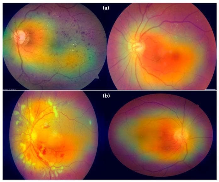 This diagnostic image displays four digital color fundus photographs with Grad-CAM heatmap overlays used for the automated classification of retinal pathologies. The images are organized into two rows: (a) Diabetic Retinopathy (DR) and (b) Hypertensive Retinopathy (HR). In the DR row, the fundus images demonstrate characteristic clinical signs including microaneurysms, intraretinal hemorrhages, and hard exudates. The heatmap overlays (red and orange zones) concentrate on these focal lesions and the macula, indicating the diagnostic importance of microvascular damage in DR. In the HR row, the retina exhibits signs of vascular hypertensive changes such as arteriolar narrowing, increased vascular tortuosity, and flame-shaped hemorrhages. The corresponding heatmaps show a more diffuse distribution, primarily following the course of the major retinal vessels and the optic disc, reflecting the systemic vascular impact of hypertension on the retinal architecture. This comparison illustrates how deep learning models utilize localized lesion detection for diabetic retinopathy versus broader vascular pattern recognition for hypertensive retinopathy.