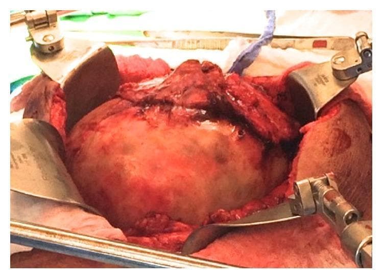 This clinical photograph captures a surgical procedure (exploratory laparotomy) showing a large, encapsulated intraperitoneal mass. The mass is exposed within the abdominal cavity, characterized by a tan-yellow hue and a smooth, dull capsular surface. It is densely adherent to the omentum, which is seen draped over the superior aspect of the lesion. Surrounding tissues exhibit signs of inflammation and potential hemorrhage, appearing erythematous and congested. Surgical exposure is maintained by multiple stainless steel retractors (part of a self-retaining retractor system) positioned along the margins of the abdominal incision. The image illustrates the intraoperative appearance of a giant abdominal pseudocyst, highlighting its anatomical relationship with the omentum and the surgical complexity involved in dissecting it from adherent abdominal structures.