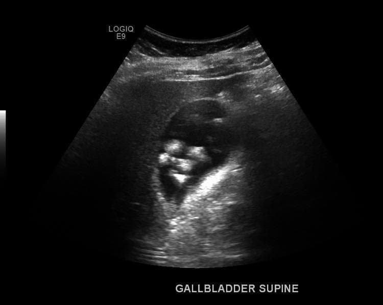 This diagnostic image is a gray-scale ultrasound of the right upper quadrant (RUQ) showing the gallbladder (GB) in a supine position. The visual focus is on the gallbladder lumen, which contains multiple distinct, hyperechoic (bright) foci. These structures exhibit classic posterior acoustic shadowing, where ultrasound waves are blocked, confirming the presence of cholelithiasis (gallstones). The gallbladder itself is non-distended. The gallbladder wall appears thin and smooth, measuring approximately 3 mm, which is within the normal physiological range. There is a notable absence of sonographic signs associated with acute cholecystitis, such as gallbladder wall thickening, pericholecystic fluid, or wall hyperemia. The adjacent hepatic parenchyma is visible but unremarkable. This image serves as a clinical example of symptomatic or asymptomatic cholelithiasis without secondary inflammatory changes of the gallbladder wall.