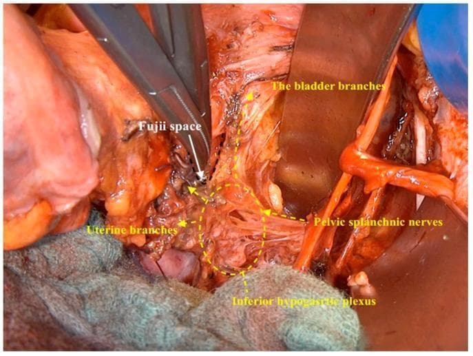 This clinical photograph captures an intraoperative dissection during a nerve-sparing radical hysterectomy, focusing on the pelvic autonomic nervous system. The image demonstrates the Fujii space, a surgical landmark located mediodorsal to the bladder branches and lateral to the vaginal wall. Surgical instruments are used to retract tissue and expose the inferior hypogastric plexus, which appears as a complex network of nerve fibers and connective tissue in the lower central field. Key anatomical structures identified via annotations include the pelvic splanchnic nerves entering the plexus and the emerging uterine and bladder branches of the inferior hypogastric plexus. The visualization highlights the spatial relationship between these neural pathways and the pelvic viscera, emphasizing the surgical technique required to isolate and preserve autonomic function. This clinical imaging is essential for understanding the surgical anatomy of the lateral parametrium and the preservation of pelvic nerves during oncological procedures in gynecologic surgery.