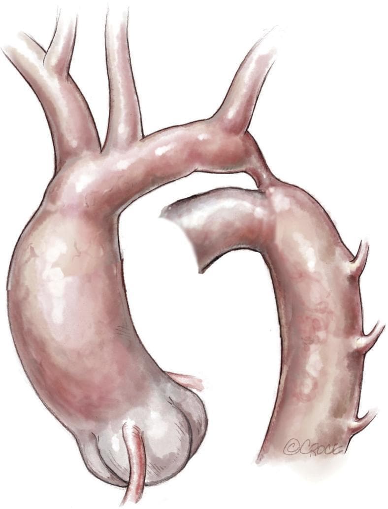 This medical illustration depicts a neonatal aortic arch with ductus-dependent coarctation. The diagram highlights several critical anatomical features: a hypoplastic and elongated distal aortic arch segment situated between the origins of the left common carotid artery and the left subclavian artery. There is a distinct stenotic isthmus, characterized by a significant narrowing of the aortic lumen just proximal to the descending aorta. A patent ductus arteriosus is shown connecting the pulmonary circulation (not fully pictured) to the descending aorta, serving as the primary conduit for distal systemic perfusion. The drawing also visualizes the brachiocephalic trunk and the intercostal arteries branching from the descending thoracic aorta. This illustration is intended for pediatric cardiology and cardiothoracic surgery education to demonstrate the morphology of complex aortic coarctation requiring surgical intervention, such as extended end-to-end anastomosis.