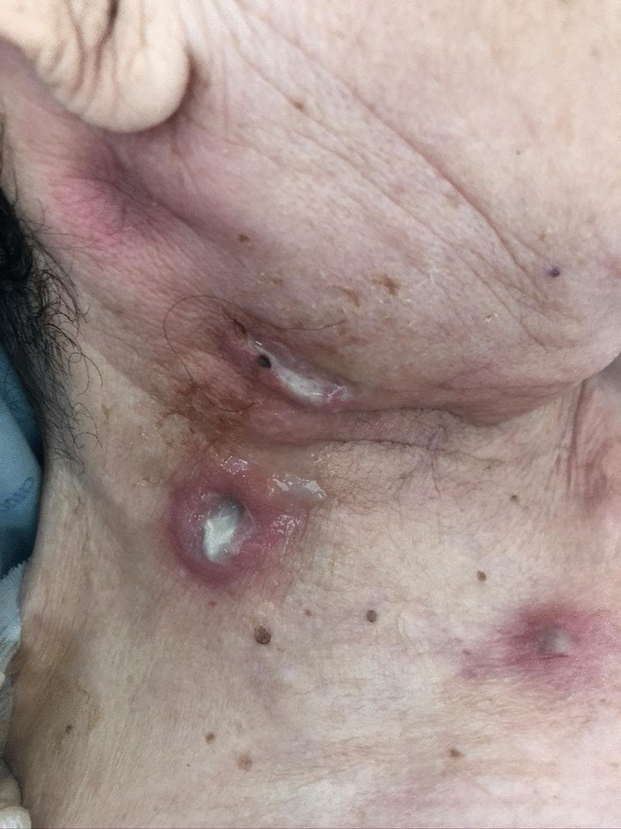 Clinical photograph of the right cervical and submandibular region of an elderly patient, showing multiple suppurative cutaneous lesions. The primary pathology consists of several tender, erythematous nodules and abscesses with central ulceration and spontaneous drainage. A prominent lesion in the lower cervical area exhibits a well-defined, raised inflammatory border surrounding a crateriform defect filled with thick, whitish-yellow purulent material. A second elongated lesion near the jawline shows similar purulent discharge and moisture, suggesting active sinus tract formation. The surrounding skin displays significant erythema and edema, consistent with localized infection. Benign seborrheic keratoses and skin tags are also visible in the periphery. Clinically, these findings represent a case of cervicofacial actinomycosis, characterized by 'lumpy jaw' syndrome with chronic abscesses and draining sinuses that may contain characteristic sulfur granules.