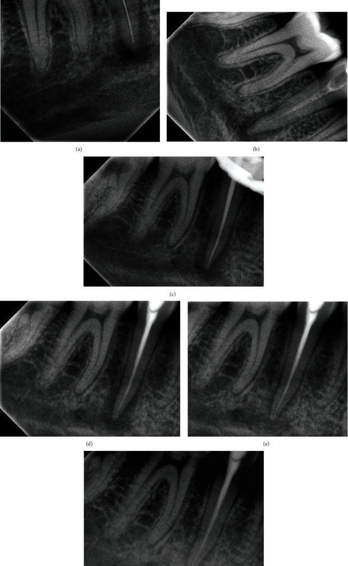 This sequence of periapical radiographs illustrates the stages of non-surgical endodontic treatment and subsequent healing of a mandibular second premolar with periapical pathology. (a) Working length determination shows a radiopaque endodontic file reaching the apical portion of the root canal. (b) Placement of calcium hydroxide intracanal medicament, appearing as a moderately radiopaque filling within the canal space. (c) Master cone selection demonstrating a radiopaque gutta-percha cone positioned at the apex. (d) Final obturation showing complete, dense radiopaque filling of the root canal system. (e, f) Follow-up radiographs at 3 and 6 months respectively. The images demonstrate progressive healing of the initial periapical radiolucency, characterized by increasing radiodensity and the reconstitution of the trabecular bone pattern and cortical lining around the apex. This timeline highlights the transition from active clinical intervention to biological bone regeneration and apical tissue repair.