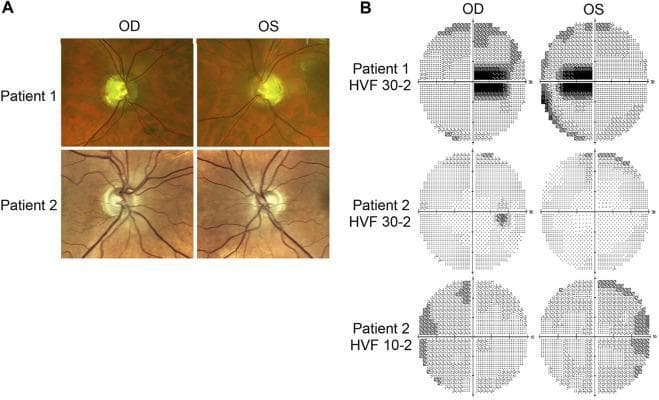 This composite educational graphic presents clinical ophthalmic diagnostic data for two patients, organized into two primary sections: fundus photography (A) and Humphrey Visual Field (HVF) testing (B). Panel A displays four fundus photographs showing the right (OD) and left (OS) eyes of two patients. Key clinical findings include bilateral temporal optic nerve head pallor, characteristic of hereditary optic neuropathies like Dominant Optic Atrophy (DOA). Patient 1 exhibits more extensive, yellowish-white pallor compared to the more localized temporal paleness in Patient 2. Panel B provides a series of perimetry reports (HVF 30-2 and 10-2). Patient 1's 30-2 tests demonstrate dense bilateral cecocentral scotomas, indicating significant loss of central vision sensitivity. Patient 2's 30-2 reports show much milder, scattered paracentral defects, while the more localized 10-2 test identifies superior temporal field loss within the central 10 degrees. This visualization illustrates the correlation between clinical optic nerve morphology (pallor) and functional visual field deficits in neuro-ophthalmology.