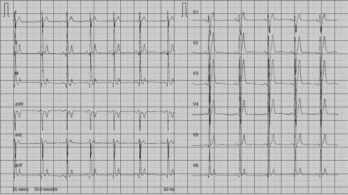 A 12-lead electrocardiogram (ECG) demonstrating the diagnostic features of Short QT Syndrome (SQTS) in a 65-year-old patient. The tracing shows a markedly abbreviated QT interval (measured at 240 ms, with a QTc of 294 ms), characterized by a short or virtually absent ST segment, with the T wave beginning almost immediately after the QRS complex. The T wave morphology is distinctive, appearing tall, peaked, and narrow across several leads, most notably in the precordial leads (V2-V4) and the inferior leads (II, aVF). The rhythm appears to be a regular sinus rhythm with a stable heart rate. These visual findings—specifically the shortened repolarization period and tall, symmetric T waves—are key clinical indicators used in the diagnosis of SQTS, a rare arrhythmogenic condition that increases susceptibility to atrial and ventricular fibrillation.
