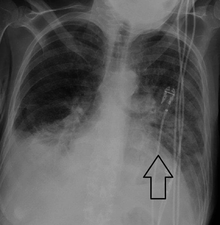 Anteroposterior (AP) chest radiograph demonstrating acute bilateral pulmonary edema. The image shows diffuse, ill-defined, hazy opacities and infiltrates throughout both lung fields, with a notable predominance and increased density in the left lung (indicated by a black arrow). These findings are consistent with alveolar and interstitial fluid accumulation. The cardiac silhouette appears enlarged, suggesting underlying cardiomegaly. Several medical devices are visible: multiple radiopaque lines (likely monitoring leads or catheters) descend through the superior mediastinum toward the cardiac silhouette, and a port-like device or pacemaker component is visible in the upper chest region. The radiograph illustrates a clinical scenario of acute heart failure or hyperbaric-induced pulmonary edema, emphasizing the loss of normal lung lucency and the obscuration of pulmonary vascular markings.