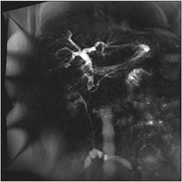 This diagnostic image is a Magnetic Resonance Cholangiopancreatography (MRCP) showing the hepatobiliary system. The visual content demonstrates significant dilation of the intrahepatic bile ducts, characterized by a prominent, branching appearance of the biliary tree within the liver. The extrahepatic biliary system, including the common hepatic duct and common bile duct (CBD), also shows marked dilatation. Key pathological findings include a filling defect at the neck of the gallbladder, indicating stone impaction and obstruction. Additionally, a rounded filling defect is visible within the distal common bile duct, consistent with a choledocholithiasis (CBD stone). These findings are characteristic of obstructive jaundice and cholecystitis. The image is an essential educational tool for illustrating biliary anatomy, the effects of mechanical obstruction on ductal diameter, and the radiological presentation of Mirizzi syndrome or combined cholelithiasis and choledocholithiasis.