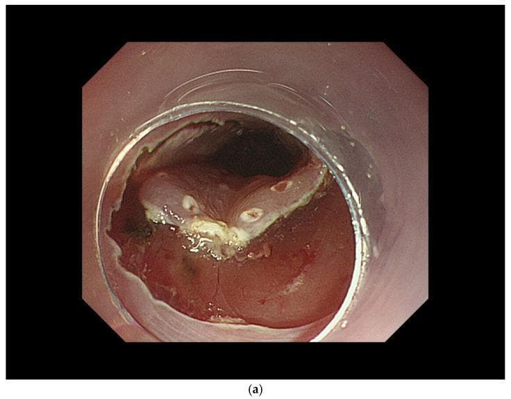 This endoscopic clinical photograph depicts a key step in Endoscopic Submucosal Dissection (ESD) of a superficial esophageal squamous cell carcinoma (SCC). The image shows the initial mucosal incision phase. Centrally, a circular transparent distal hood (cap) is attached to the endoscope to maintain a stable field of view and provide tissue tension. A circumferential mucosal incision is visible, characterized by a sharp boundary where the mucosal layer has been cut, exposing the underlying whitish-yellow submucosal layer. The surrounding esophageal mucosa appears erythematous and slightly edematous, consistent with the procedural trauma and inflammatory response. The lumen beyond the lesion is visible as a dark aperture. This stage is critical for defining the lateral margins of the en bloc resection, allowing subsequent dissection of the submucosa to separate the lesion from the muscularis propria.