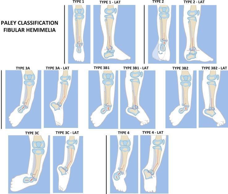 This medical illustration presents the Paley classification system for fibular hemimelia, a congenital deficiency of the fibula. The diagram is organized by anatomical severity, featuring both anterior (AP) and lateral (LAT) views for each type. Type 1 shows a stable ankle with a nearly full-length fibula. Type 2 illustrates dynamic valgus instability where the distal fibular physis is proximal to the ankle joint line. Type 3 is characterized by fixed equino-valgus deformities and is subdivided: 3A (ankle type) showing distal tibial malorientation; 3B (subtalar type) involving subtalar coalition with (3B1) or without (3B2) a visible distal fibular remnant; and 3C (combined) featuring both tibial and subtalar malalignment. Type 4 depicts a fixed equino-varus deformity with subtalar coalition. Key visual markers include the mechanical axis of the tibia (red line), the orientation of the distal tibial physis, the presence/absence of the fibula, and the articulation of the talus and calcaneus. This orthopedic diagram serves as a clinical guideline for reconstructive surgical planning in pediatric lower limb deficiencies.
