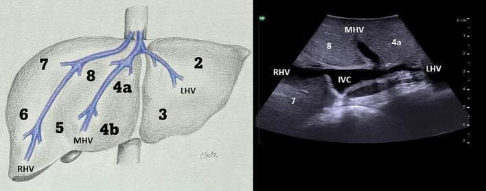 This educational graphic consists of an anatomical diagram and a corresponding transverse ultrasound image demonstrating hepatic venous anatomy and Couinaud liver segments. The diagram (left) illustrates the superior drainage of the liver into the inferior vena cava (IVC) via three primary hepatic veins: the right hepatic vein (RHV), middle hepatic vein (MHV), and left hepatic vein (LHV). These vessels serve as landmarks for segmental anatomy, with segments 2 through 8 labeled according to their spatial relationship to these veins. The ultrasound image (right) displays a transverse view at the superior level of the liver. The IVC appears as a central, relatively anechoic structure. The hepatic veins are visible as anechoic tubular structures draining into the IVC, creating the characteristic 'rabbit ears' appearance. Labels on the sonogram identify the RHV, MHV, and LHV, as well as segments 7, 8, and 4a. The surrounding hepatic parenchyma exhibits a homogeneous, medium-level echogenicity. This comparison facilitates the understanding of intraoperative ultrasound landmarks for surgical resection and anatomical localization.