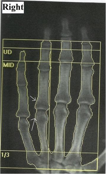 This monochrome diagnostic image is a Dual-Energy X-ray Absorptiometry (DEXA) scan of the right hand, presented in a posterior-anterior orientation. The scan captures the distal metacarpals and the phalanges of the second through fifth digits. Superimposed on the anatomy is a yellow analysis grid with horizontal markers labeled 'UD' (ultra-distal), 'MID' (middle), and '1/3' (distal shaft), which are standard regions of interest for bone mineral density quantification. White arrows indicate juxta-articular osteopenia at the proximal and middle phalanges of the second digit, characterized by increased radiolucency and reduced bone density near the joint margins. This visual finding is characteristic of regional osteoporosis, often associated with Complex Regional Pain Syndrome (CRPS) Type I. The image serves as a clinical example of using DEXA imaging to diagnose and monitor metabolic bone changes in peripheral extremities following localized trauma or neurological insult.