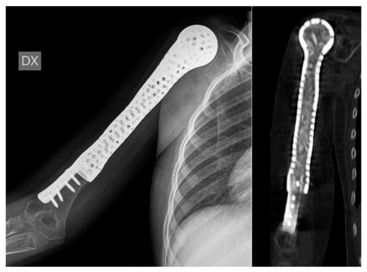This composite diagnostic image features an anteroposterior X-ray (left) and a coronal CT reconstruction (right) of a pediatric humerus following limb-salvage surgery for Ewing’s sarcoma. The image demonstrates a 3D-printed, custom-made hollow prosthesis replacing the proximal and mid-diaphysis of the humerus while preserving the distal native bone and elbow joint. The prosthesis exhibits a distinctive porous structure with multiple radiolucent perforations throughout its radiopaque shell, designed to facilitate revascularization of internal bone grafts from surrounding soft tissues. The distal end of the implant features a wide collar that circumferentially overlaps the remaining humeral bone, secured by multiple transverse screws. The CT scan confirms the hollow nature of the internal chamber, which is packed with morselized allograft cortico-cancellous bone chips, visible as heterogenous, semi-dense material within the high-density prosthetic shell. This setup highlights orthopedic oncological techniques for pediatric reconstruction, focusing on biological integration and joint preservation.