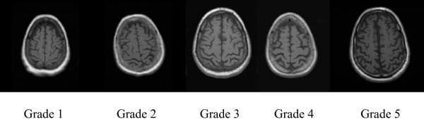 This diagnostic image series presents a five-panel comparison chart illustrating the progression of cortical atrophy as visualized on axial T1-weighted MRI scans of the brain. The images demonstrate a visual grading scale ranging from Grade 1 to Grade 5, based on the Cardiovascular Health Study grading system. Grade 1 shows a healthy brain state with narrow, closely spaced sulci and minimal visible cerebrospinal fluid (CSF) on the cortical surface. As the grading progresses toward Grade 5, there is a clear incremental increase in sulcal dilatation and widening of the cortical subarachnoid spaces, reflecting progressive cortical tissue loss. By Grade 5, the gyri appear thinner and the CSF-filled sulci are markedly prominent and enlarged. This visual reference serves as a clinical teaching tool for neuroradiological assessment of age-related or neurodegenerative brain volume loss, highlighting the loss of parenchyma and subsequent ex vacuo expansion of CSF spaces.